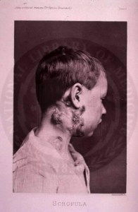 Scrofula