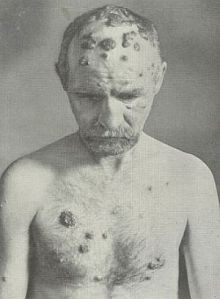 Medical photo of a man suffering with pustular syphilis